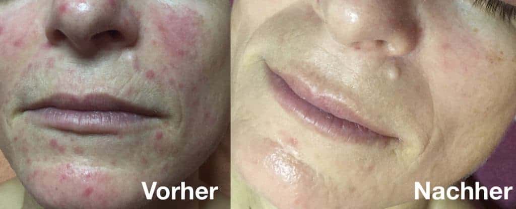 Rosacea Hannover Behandlungsergebnisse