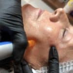 Microneedling Hannover