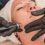 Mikrodermabrasionsbehandlung Kosmetikstudio Silke Butenholz Hannover